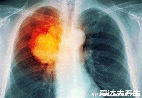 三个征兆说明已有肺癌